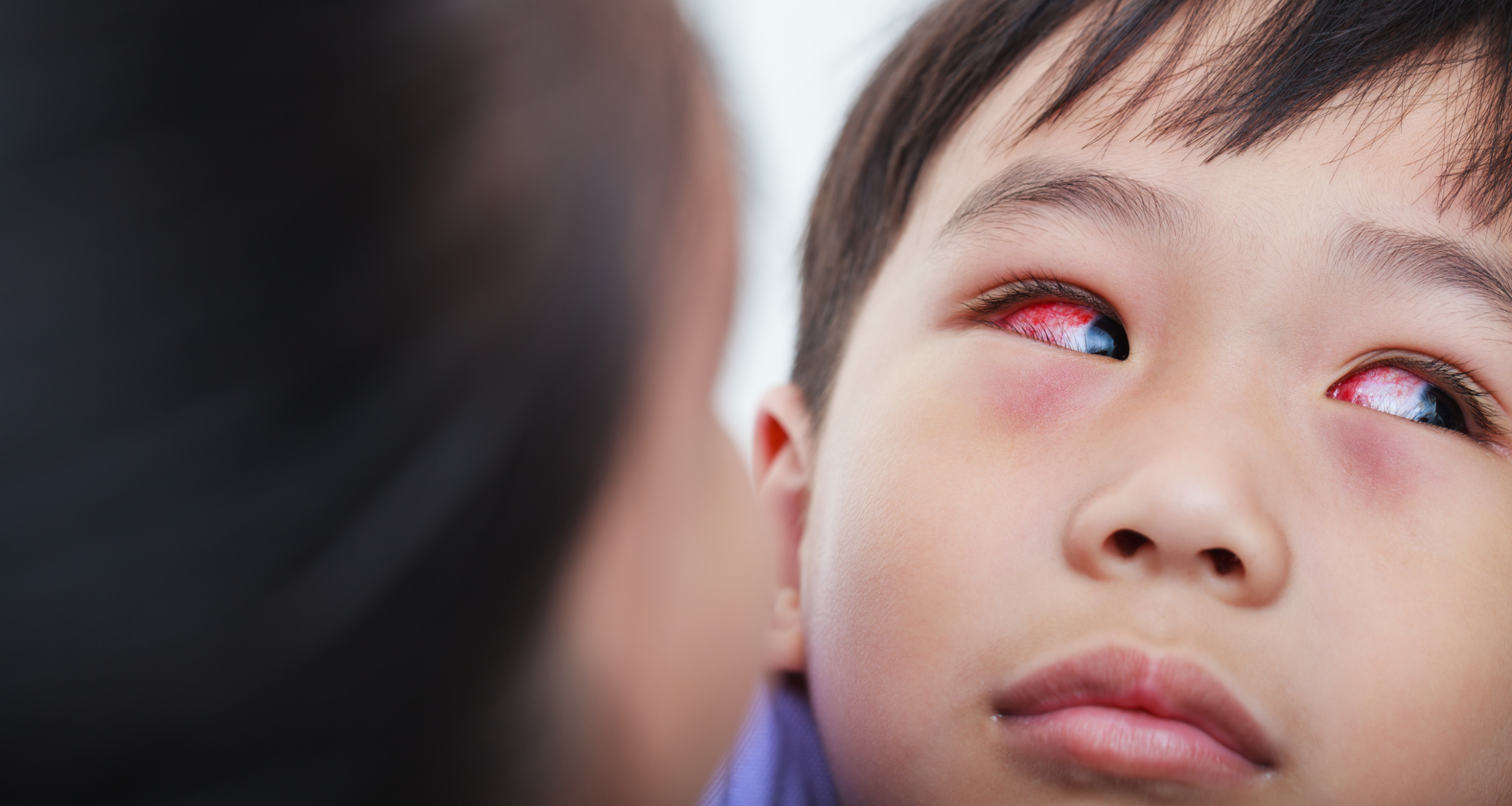 Child with red itchy eyes showing allergic conjunctivitis symptoms