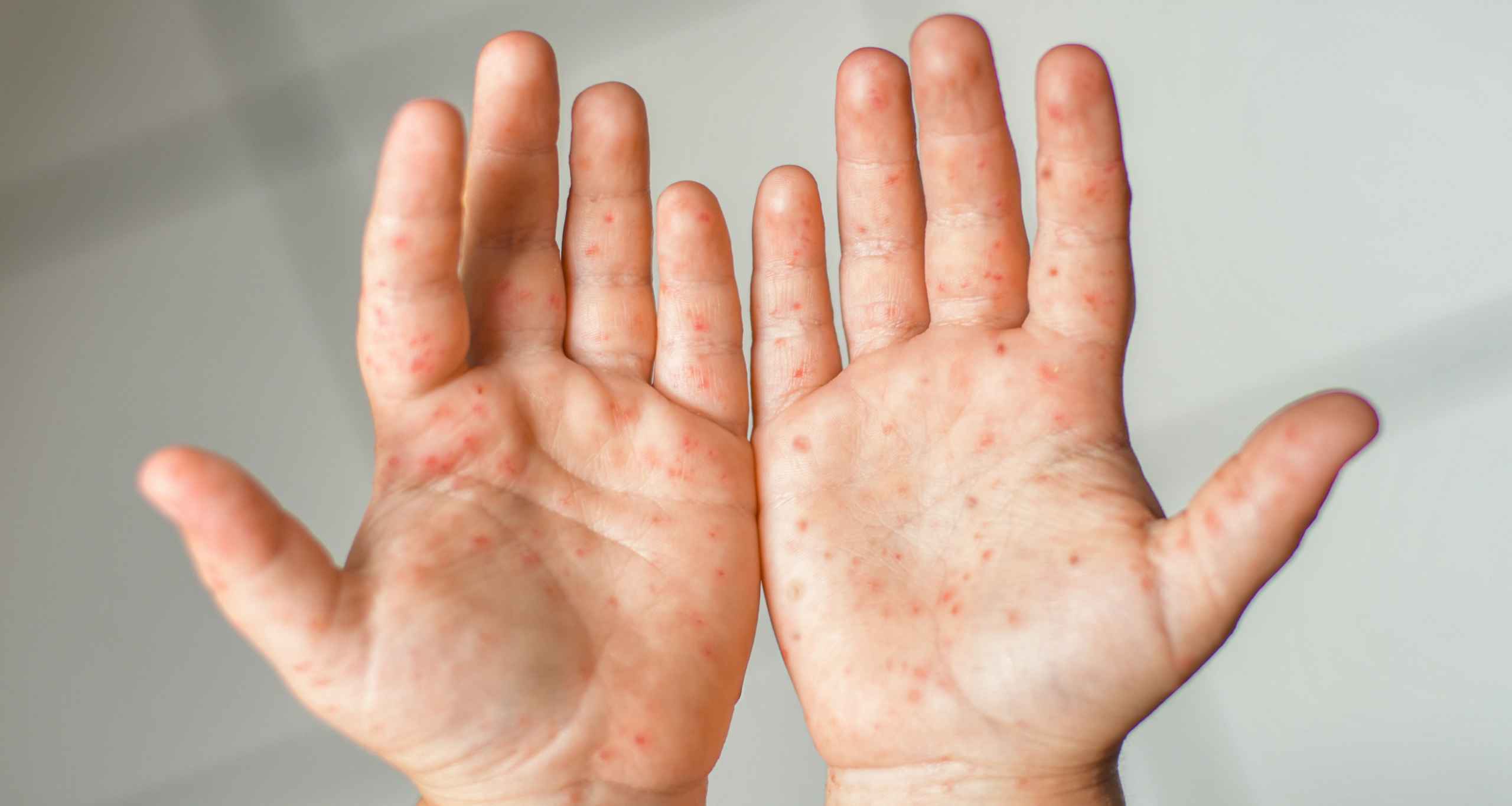 A pediatric dermatology Dubai specialist examining a young child’s skin for signs of Eczema